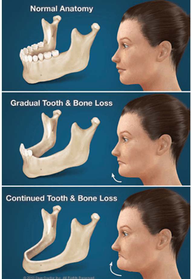 denture1 - Complete Dentures - Guy Dentistry