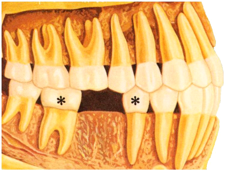 missing1 - Dental Bridges - Guy Dentistry