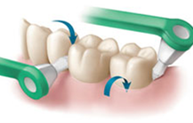 sulcabrush - Crown & Bridge Home Care Instructions - Guy Dentistry